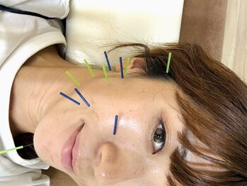 おぐの和の写真/【美容鍼×肌育】女性鍼灸師による肌質改善◎肌の深部までアプローチ☆1日1名限定のお得なsetクーポン有♪
