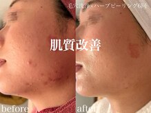 ネオリー(neorii)/毛穴洗浄＋ハーブピーリング