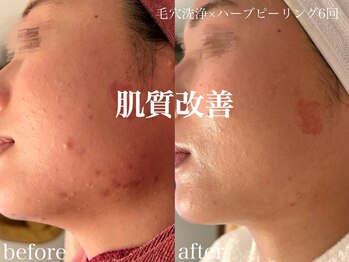 ネオリー(neorii)/毛穴洗浄＋ハーブピーリング