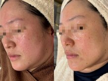 エミュ(emu)/赤み改善とリフティング