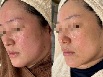 エミュ(emu)/赤み改善とリフティング