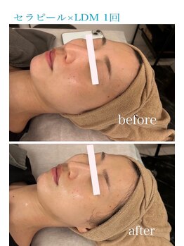 プレジール(Plaisir)/艶肌爆弾セラピール+LDM