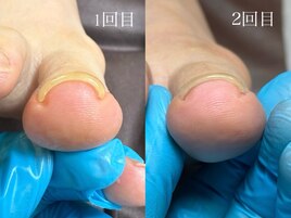 巻き爪ケアジェル