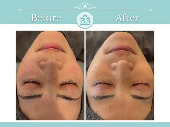 美人プラス 幸田店/【シミケア☆シミゼロ症例】