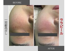 ウルオイ 海老名(URUoi)の雰囲気（《ララピール》お肌のお悩みにアプローチ(写真は1回での結果)）