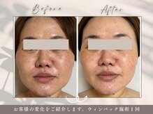 碧(ao)/ウィンバック１回だけの効果