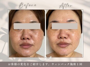 碧(ao)/ウィンバック１回だけの効果