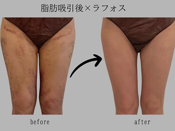 プレリー 自由が丘店/術後ケア　ラフォス