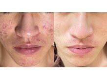 アティロン(Attirant)/【にきび、酒さ・赤ら顔】 