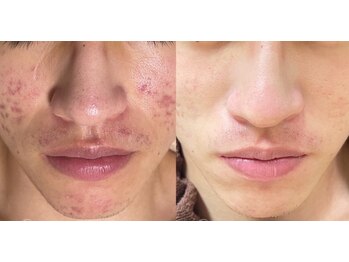 アティロン(Attirant)/【にきび、酒さ・赤ら顔】 