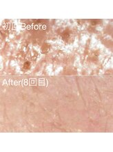 ミニョスキンラボ/韓国式ハーブピーリング8回