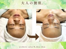 アール シュシュ(R.chouchou)/大人の水光肌プログラム