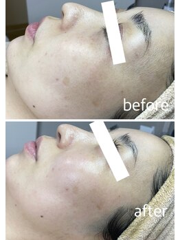 サロン ド ソワン(salon de soin)/毛穴×ハーブピーリング