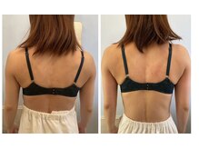 メゾン アンジュ(Maison Ange)/バストアップ症例【背中】バスト