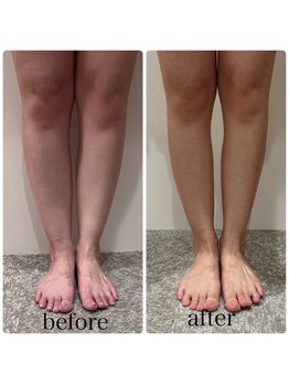 ハチ シンス 2023-(hachi-since 2023-)/セルフ痩身 Before・After