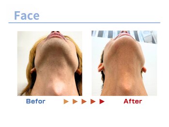 キングスサロン 熊本/メンズ髭脱毛ビフォーアフター