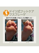 フスフレーゲ 学芸大学店/タコの痛み