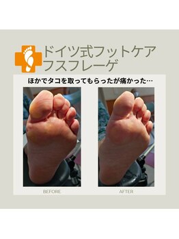 フスフレーゲ 学芸大学店/タコの痛み