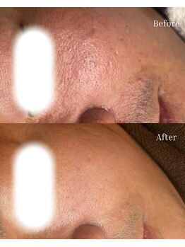 ベリスユイット(BELLIS HUIT)/【剥離なしハーブピーリング】