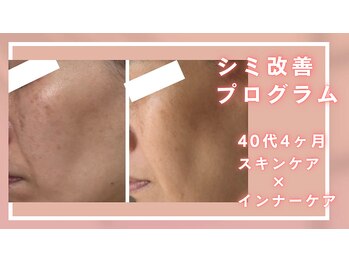 シャルナ(charna)/シミ改善プログラム