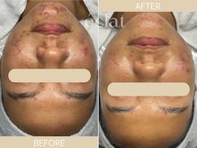 エクラ(eclat)の雰囲気（最先端美容機器☆ピーリングなし/ダウンタイムなしの毛穴ケア）