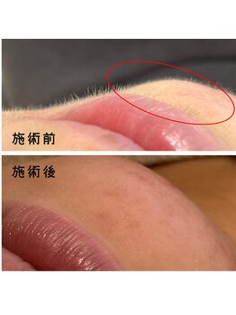 フルールスレーヌ(Fleur Sereine)/シュガーリング+光脱毛