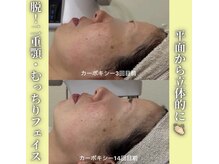 ハニエル(Haniel)/カーボキシー症例