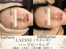 エスポワール(espoir)/繰り返す右頬・顎ニキビが改善！