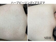 ウェルビー(Well-Be)/ハーブピーリング＋プラズマ