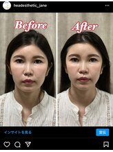 ジェントラ(Jentra)/予防と改善　小顔モニター