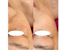 クオルーチェ(CuoLuce)/光フェイシャル（シミケア）