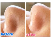 リジュベ 古河店(Rejuve)/毛穴エクストラクション