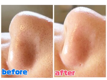 リジュベ 古河店(Rejuve)/毛穴エクストラクション