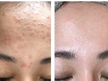 シード(SHE°)/剥離なしハーブピーリング