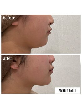 エフイチキュウサン(f.193)/ビフォーアフター