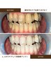 【早い・しみない◎】1回でも変化がわかる！ホワイトニング8分×2