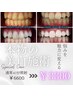 【本物の美白歯】黄ばみ撃退★￥6600→￥3300