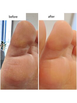 ケアプラス(care plus)/足裏角質ケア