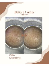 ハルハル(Haru Haru)/毛穴(クレンジング洗顔のみ)