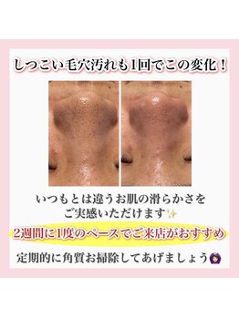 アルムダアクア 天王寺店(Aleumda AQUA)/ハーブピーリング/大阪/天王寺