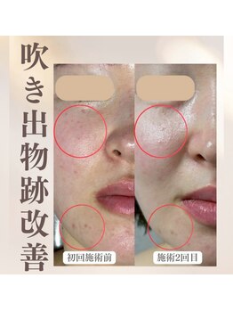 スリーピングビューティー(Sleeping Beauty)/ニキビ、毛穴改善