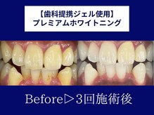 ホワイトニングカフェ 岸和田店(WhiteningCafe)/◎歯のホワイトニング施術写真◎