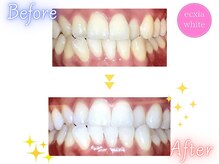 エクシアホワイトニング 原宿店/ホワイトニングビフォーアフター