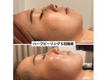 スピード美人 横浜店/ハーブピーリングで陶器肌へ