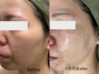 サロンドジェシカ(salon de Jessica)/プラズマ　頬毛穴