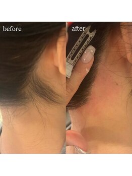 エクシア 平塚(EXIAR)/ 【うなじwax脱毛+眉毛】