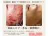 【継続ケアで肌質改善】タラソ導入×赤ニキビ集中ケア ¥16,500