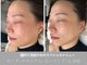 イロハ(IROHA)の写真/次世代最強小顔施術*オンダリフト導入サロン◆二重顎/たるみ/もたつきに!脂肪減少・効果を即実感♪