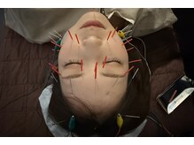 チャチャエイム整骨院 鍼灸院/【美容鍼】 根本から改善！