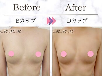 メディカルサロン エム エム エム 銀座プレミアムサロン(M.M.M.)/【バストアップ例】 B→Dカップ